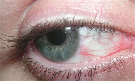 Red Spot In Eye