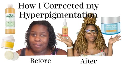 My Tips And Tricks To Cure Hyperpigmentation And Skin Discoloration