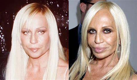 Celebrity Plastic Surgery Gone Bad Really Bad News Stories