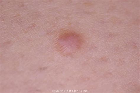 Dermatofibroma South East Skin Clinic Blog