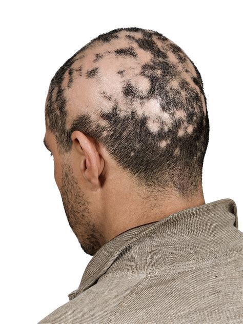 Hair Toppiks New Hair Cover Up Product from Toppik