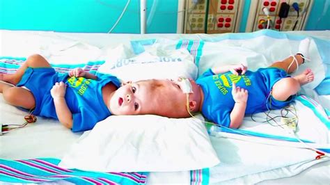 Conjoined Twins Attached At Head Separated After Surgery In New York
