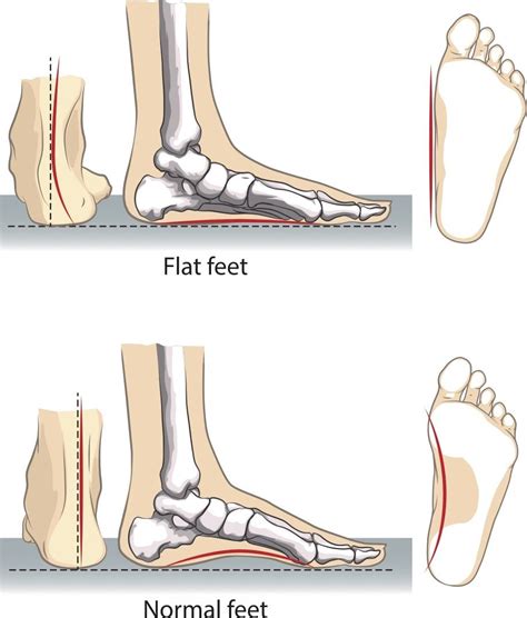 Flat Foot Sussex Foot And Ankle Clinic