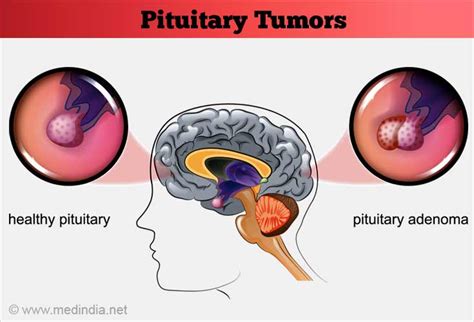 pituitary tumors causes symptoms diagnosis treatment