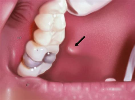 Oral Cavity And Pharynx Plastic Surgery Key