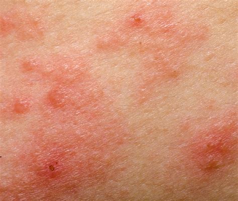 Dermatite Atopica Cause Cura Alimentazione E Rimedi Naturali Mobile