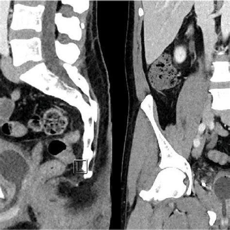 Contrast Enhanced Ct Of The Abdomen And Pelvis Sagittal Left And