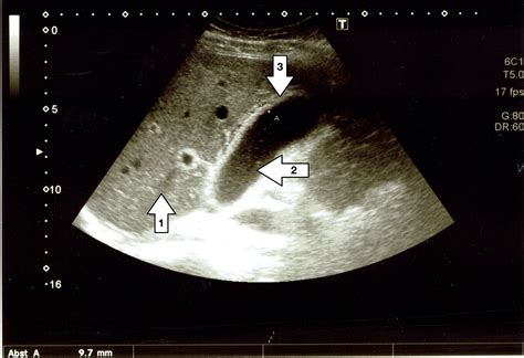 Cureus Riddle Me This Acalculous Cholecystitis As An Unusual