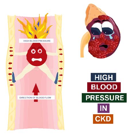 High Blood Pressure In Ckd All Things Kidney Official