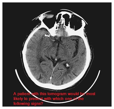 Level 17 Nejm Image Challenge Memrise