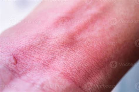 Skin Allergy With Rash After Mosquito Bite 11673692 Stock Photo At Vecteezy