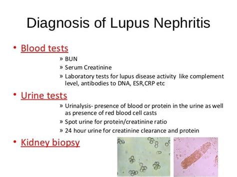 Pruebas De Laboratorio Utilizadas Para Diagnosticar Lupus Limitaciones