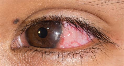Corneal Infection And Other Causes Of Red Eye Rila Institute Of