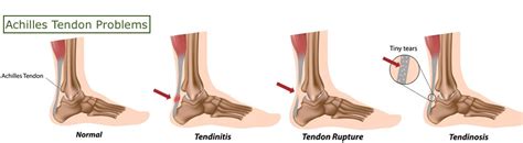 Ankle Pain Causes And Treatments Complete Pain Care
