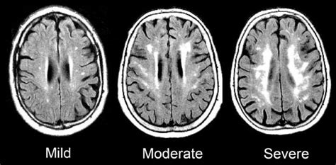 Mri Links Inflammation To Cognitive Decline