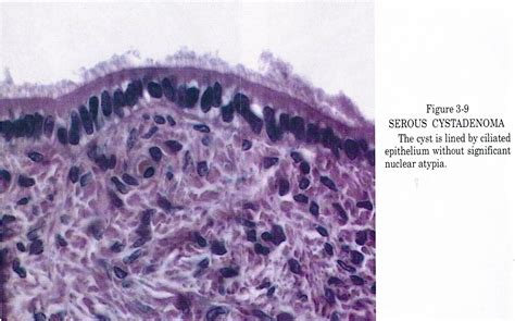 Pathology Outlines Serous Cystadenoma Adenofibroma Surface Papilloma