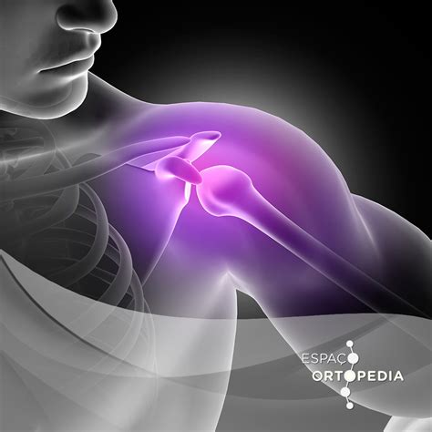 Principais causas e como tratar a dor no ombro Espaço Ortopedia