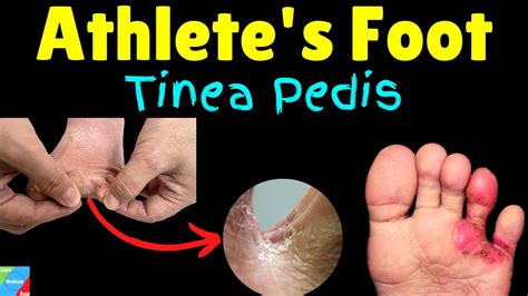 Athlete S Foot Tinea Pedis Symptoms Causes Treatment Foot Fungus Youtube
