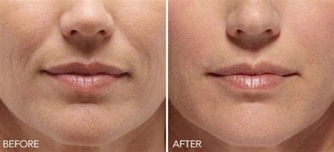 Smile Lines Fillers In Cobham Esher Surrey And Wimbledon Face