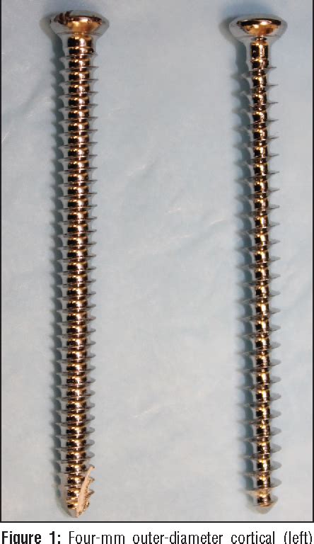 Figure 1 From Cancellous Screws Are Biomechanically Superior To