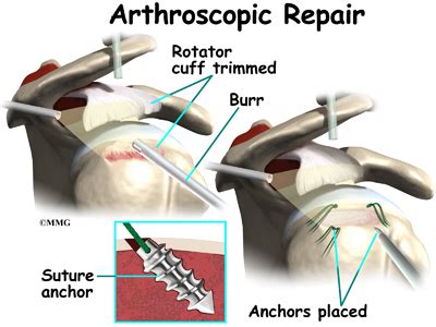If your rotator cuff is injured, you may need surgery to repair it. Rotator Cuff Tears | eOrthopod.com