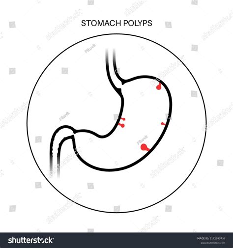 Stomach polyps logo, diagnostic and removal - Royalty Free Stock Vector