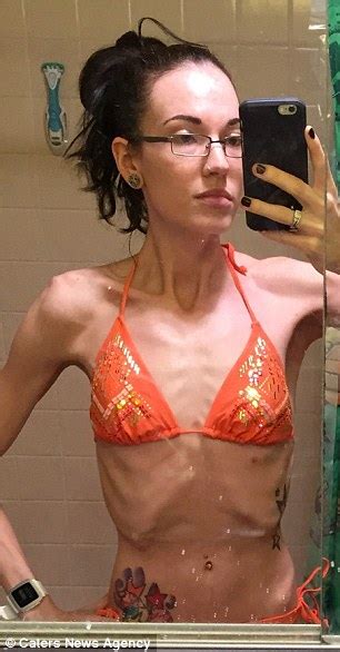 Anorexic Gym Addict Whose Weight Fell To 6st Finally Hit A Healthy