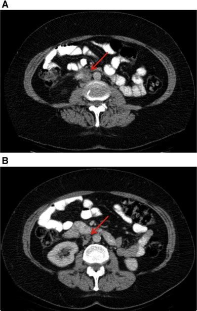 A Ct Scan Of Abdomen And Pelvis With Iv And Oral Contrast 9months