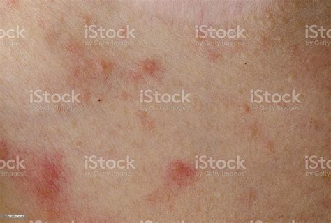 Erupción De La Piel Dermatitis Alérgica Eccema Foto De Stock Y Más