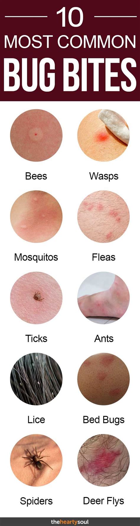 10 Bug Bites Anyone Should Be Able To Identify Bug Bites Insect Bites Health And Beauty Tips