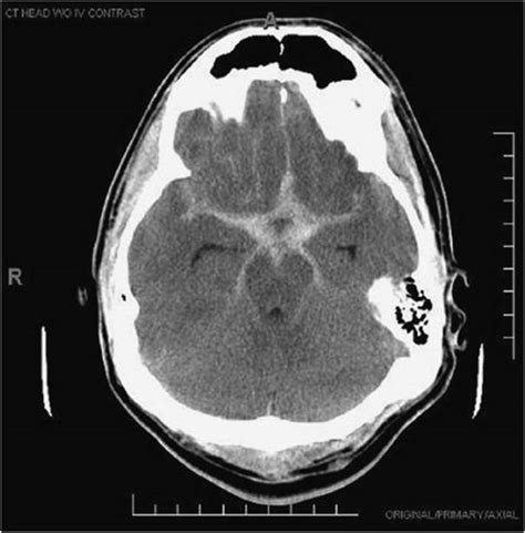 Subarachnoid Hemorrhage Neurology Internal Medicine Correlations