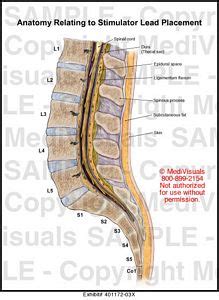 The mckenzie back stretches are a specific set of. Anatomy Relating to Stimulator Lead Placement Medical ...