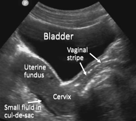 Pelvic Ultrasound Sagittal Anatomy