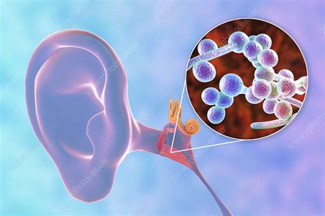 Chronic Fungal Otitis Media Ear Infection Illustration Stock Image