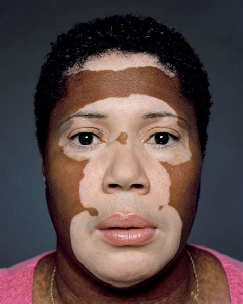 How To Cure Vitiligo On Lips