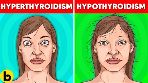 Age, being female, and exposure to radiation are the most common risk factors. Is Your Thyroid The Cause Of Your Insomnia