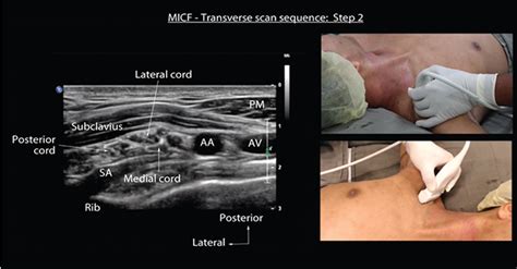 Ultrasound Guided Costoclavicular Brachial Plexus Block For Images And Photos Finder