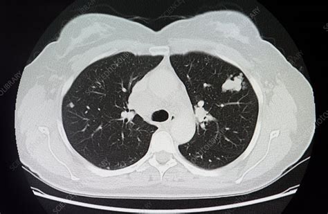 Melanoma Lung Cancer Ct Scan Stock Image C0151233 Science Photo Library
