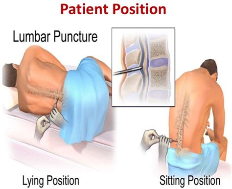Lumbar Puncture Spinal Tap Jabovillage