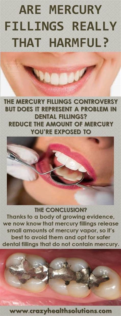 Gallery dental offers an alternative to silver fillings: Are Mercury Fillings Really That Harmful? | Dental ...