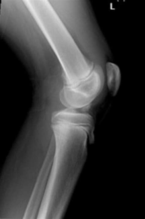 Traumatic Knee Pain In A Child The Bmj
