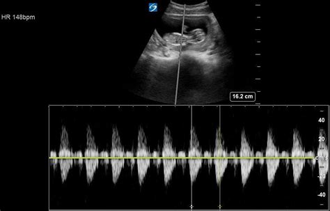 M Mode Yes Vs Doppler No Alara Fetal Heart Rate — Everyday Ultrasound