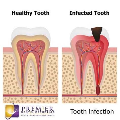 Tooth Infection Abscessed Tooth Pain Relief Causes Emergency Treatment Prevention