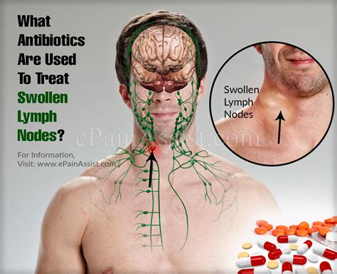 What Antibiotics Are Used To Treat Swollen Lymph Nodes