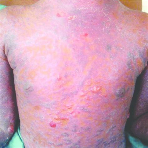 Multiple Erythematous To Violaceous Papules Plaques And Tense Bullae