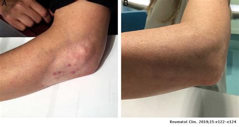 Treatment Of Persistent Cutaneous Atrophy After Corticosteroid