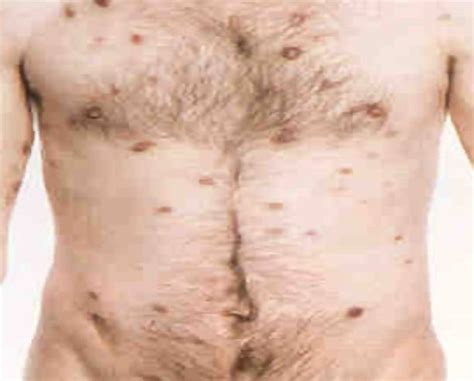 Hiv infection happens in three stages. HIV AIDS Symptoms | eMedical Help