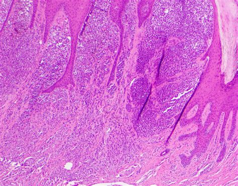 Pathology Outlines Acral Melanoma