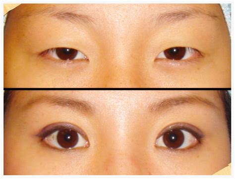 Dr Vanessa Neoh Double Eyelid Aesthetic Eyelid Surgery