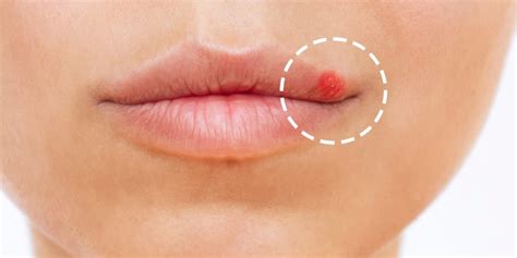 How To Get Rid Of Lip Pimple Useful Tips
